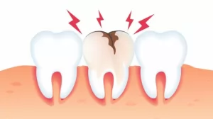 Penyebab Sakit Gigi Berlubang yang Perlu Diketahui